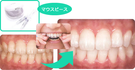ホワイトニング